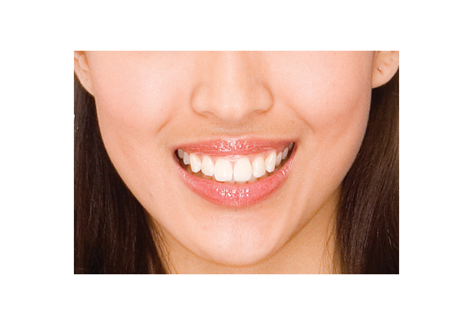 Teeth Whitening System Sharper Image