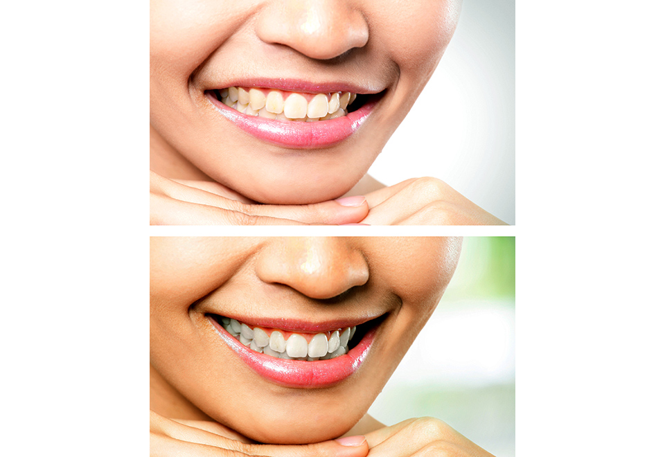 Professional Teeth Whitening System Sharper Image