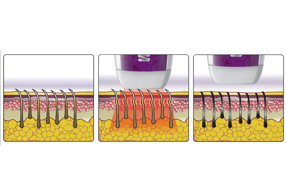 AtHome Professional Hair Removal System Sharper Image