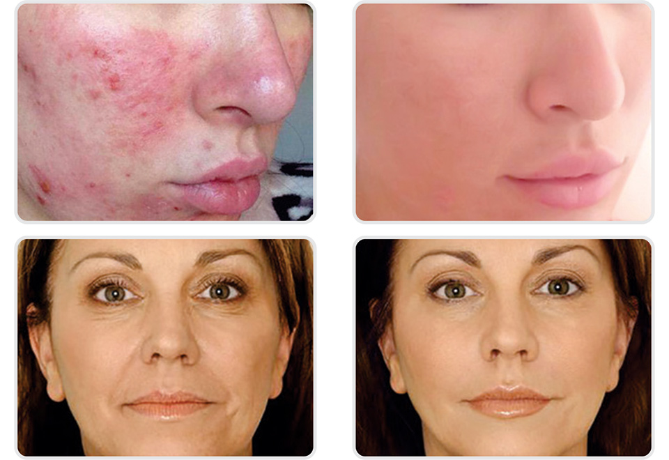 Portable Professional AntiAging Light Therapy System Sharper Image