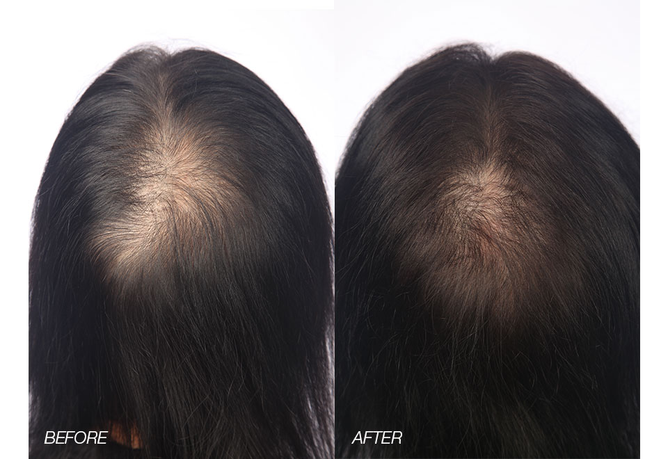 Professional Laser Hair Growth Band Sharper Image